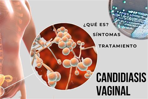 Candidiasis vaginal: qué es, causas, síntomas y tratamiento